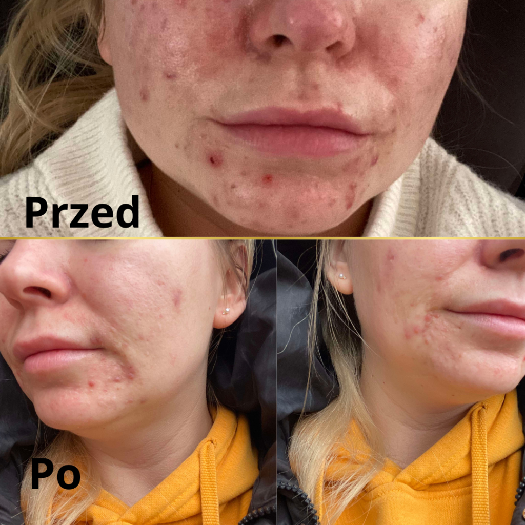 onkologia, kosmetyka onkologiczna, rak tarczycy, problemy ze skórą twarzy po przebytym raku tarczycy