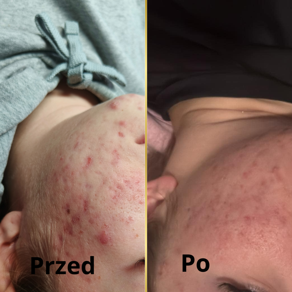zaawansowany trądzik, nieleczone stany zapalne, trądzik młodzieńczy