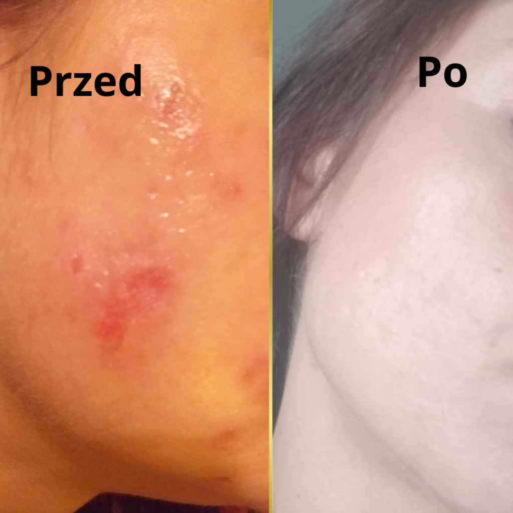 oparzenia powstałe po nieumjiejętnym używaniu kosmetyków