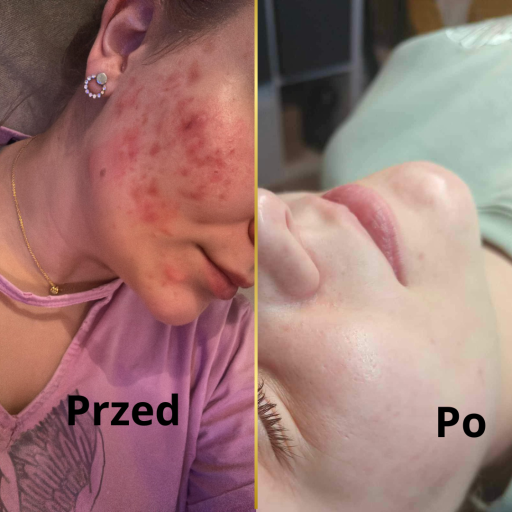 wyzwanie tej skóry twarzy. bardzo zaawansowane stany zapalne