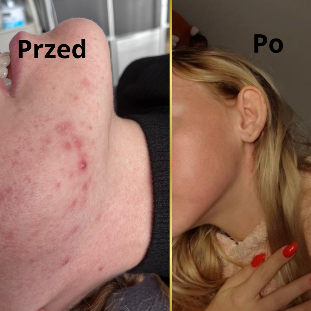 zła pielęgnacja twarzy i grudkowate zmiany podskórne